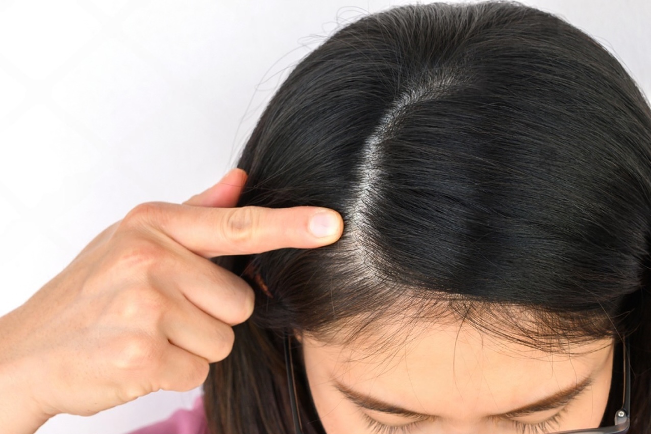 Female Pattern Hair Loss Treatment Female Pattern Hair Loss Treatment
